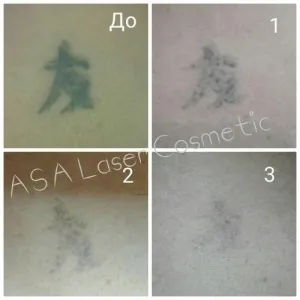 Лазер для видалення тату ASA | LC Tattoo Laser - фото 37148